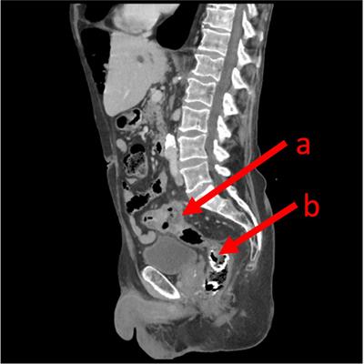 Case report and narrative review of the literature: a rare colonic stent failure in a palliative patient